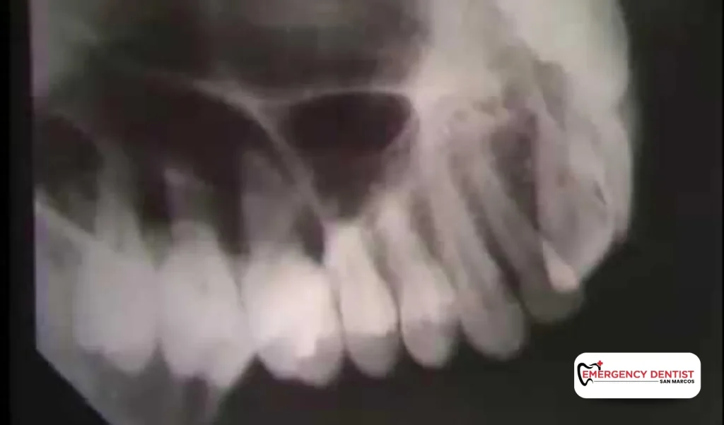 Types of Dental X-Rays