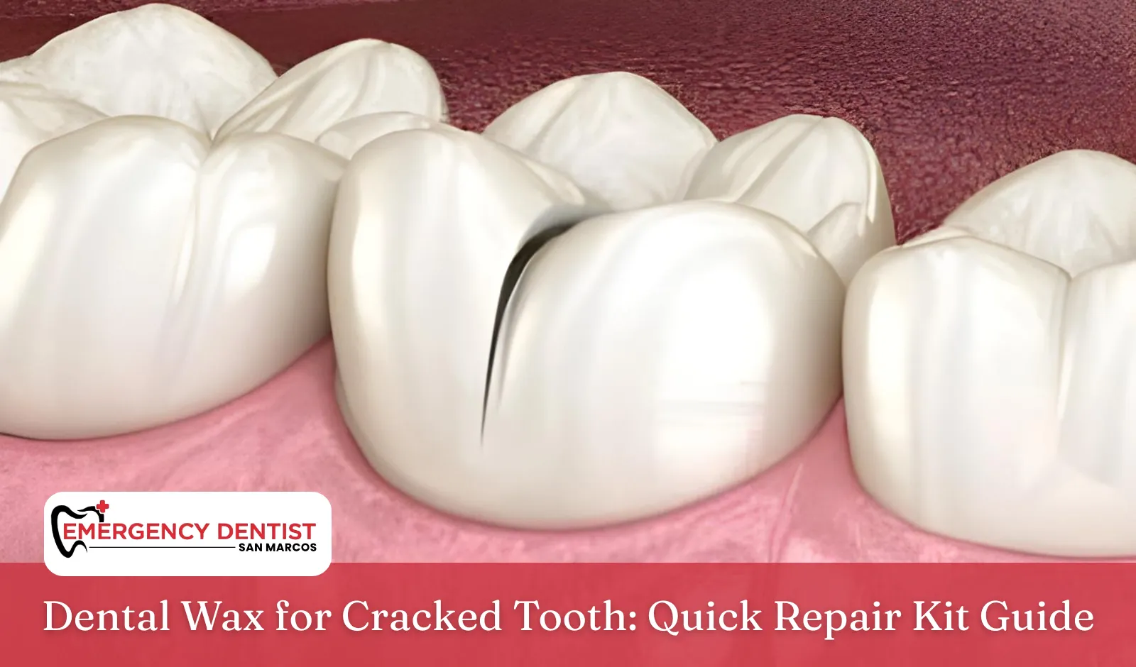 Dental Wax for Cracked Tooth: Quick Repair Kit Guide
