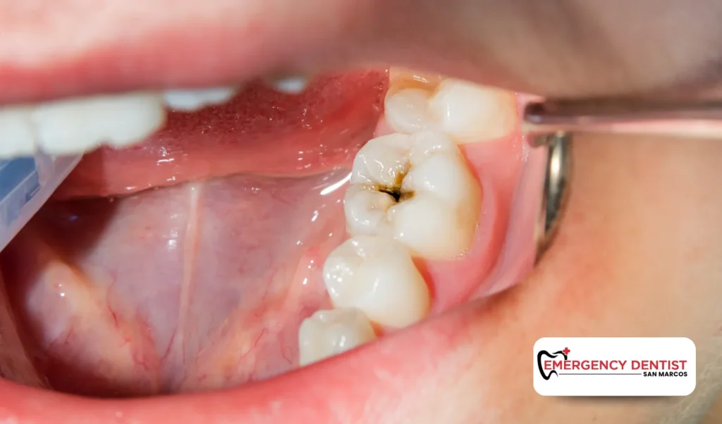 Common Causes of Dental Infections