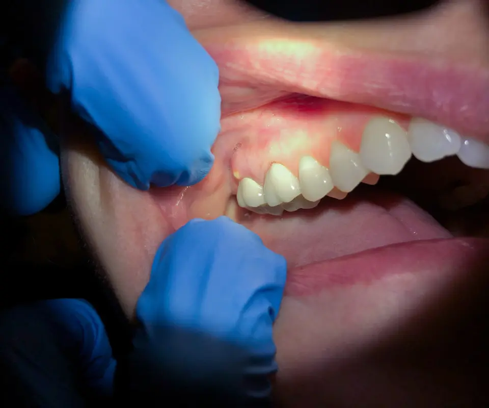 Tooth-Abscess-San-Marcos-CA