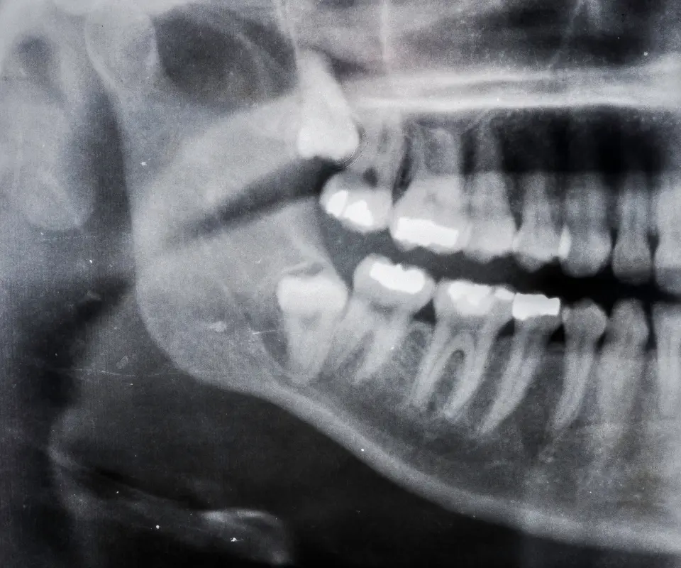 Wisdom-Tooth-Complications-San-Marcos-CA